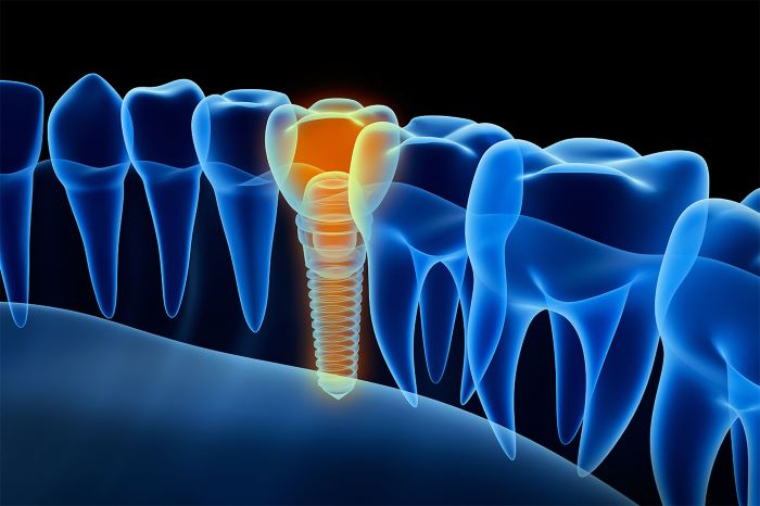 Dental Implant Right