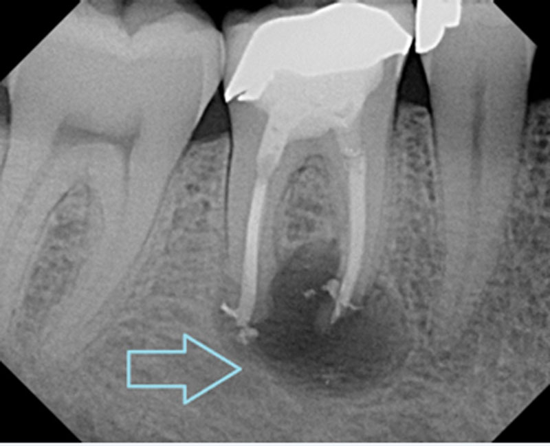 Endodontist London: Common Dental Problems They Treat 2 https://spokanedental.blob.core.windows.net/content/images/blog/Karissa%20-%20What-is-a-Dental-Abscess.jpg?utm_source=chatgpt.com