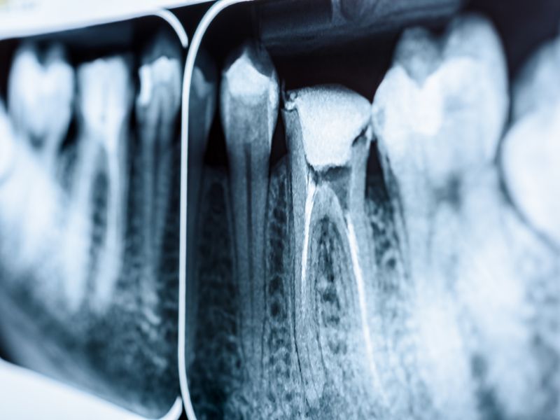 Root Canals Extractions