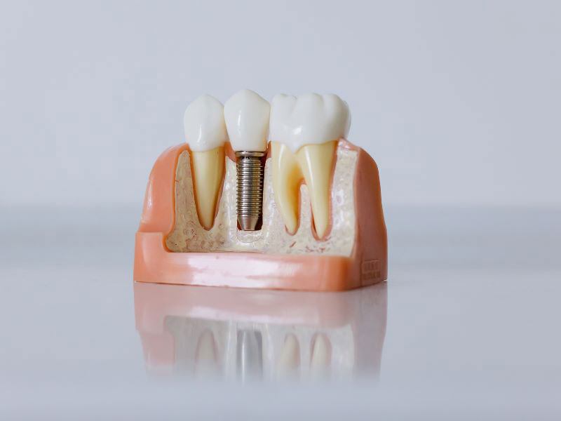 Advantages Dental Implants