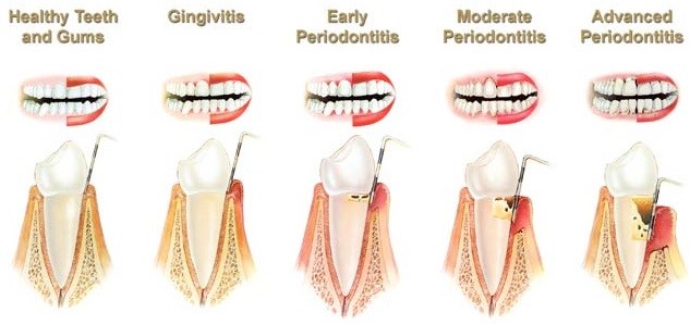 Healthy Gums because of cleaning