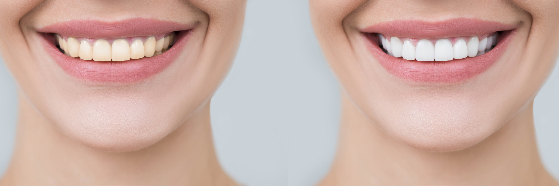 Teeth Whitening Spokane
